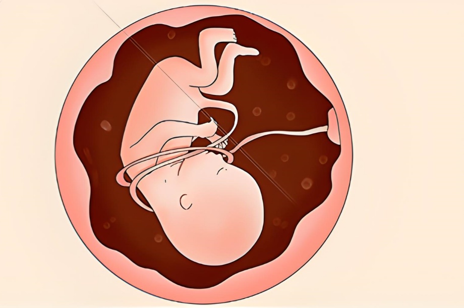胎儿检出脐带缠绕数天后死亡，孕妇家属称医生风险评估不到位